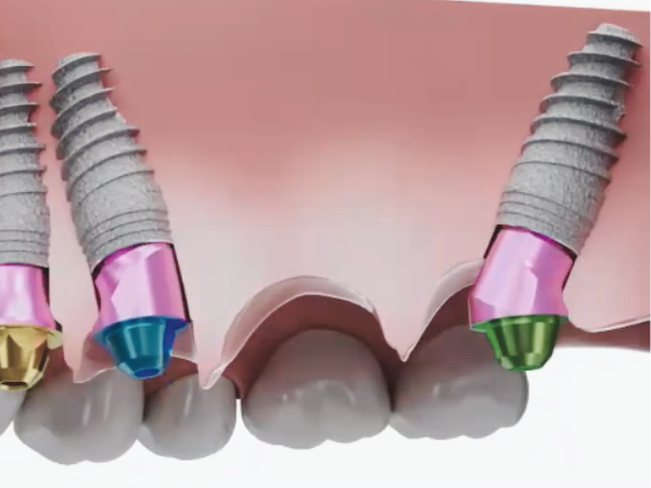 마곡동치과_3. 상악동거상술 없이 임플란트 가능할까요? 되는 조건 정리 관련 이미지 3