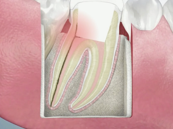 마곡치과_4. 신경치료 후 통증, 재신경치료와 발치 어떤 선택이 맞을까요? 관련 이미지 2