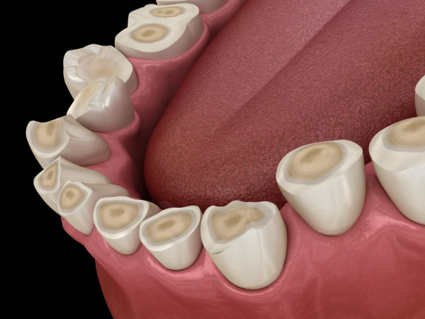 마곡동치과_ "찬물에 시리고, 이가 짧아졌다면?"[3. 치아마모 증상] 관련 이미지 2