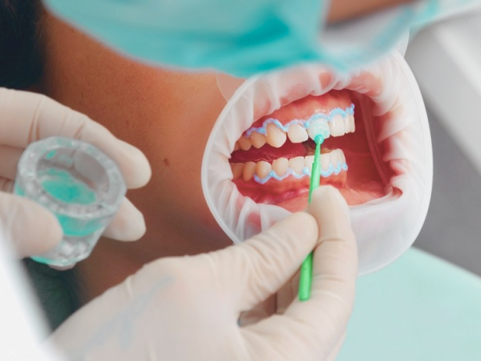 마곡역치과_ &ldquo;집에서 하얀 치아 만들기!&rdquo;[3. 생활치 자가미백 치료 특징과 과정 ] 관련 이미지 7