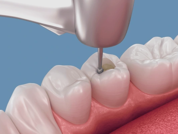 마곡역치과_4. 치수염이면 무조건 신경치료 해야 할까요? 단계별 기준 정리 관련 이미지 1