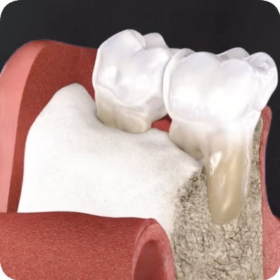 Maggok Dental_3. Gum Surgery: When Periodontal Flap Surgery Is Needed and the Treatment Process image 4