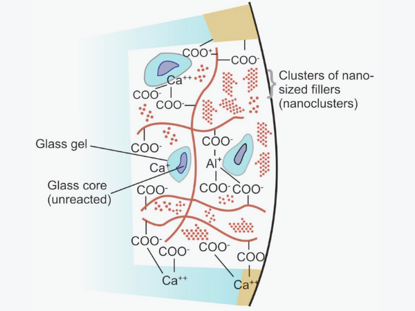마곡역치과_ 1. 글래스아이오노머(GI) 특징과 장단점 관련 이미지 5