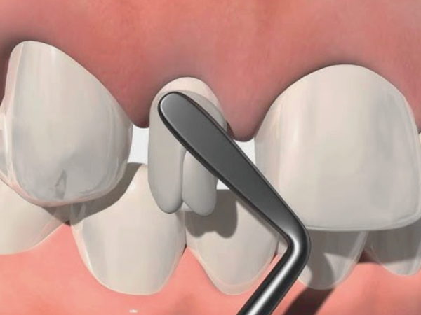 마곡역치과_4. 왜소치, 디아네이트 무삭제 라미네이트 케이스 관련 이미지 2