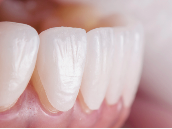 마곡역치과_3. 레진변색, 디아네이트 무삭제 라미네이트 케이스 관련 이미지 3