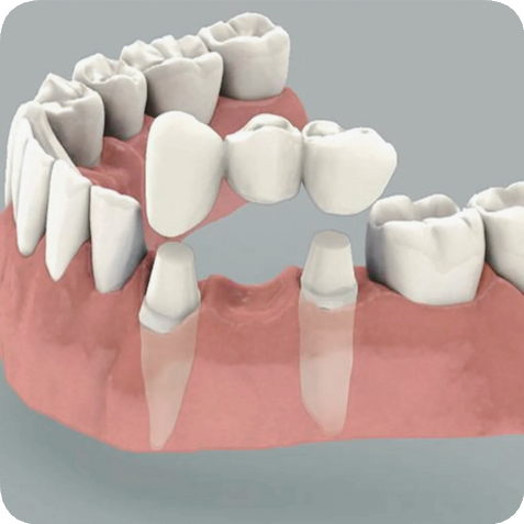 마곡역치과_ 충치, 풍치, 외상으로 치아 빠졌다면? [ 2. 임플란트가 필요한 경우 ] 관련 이미지 8
