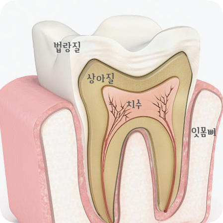 마곡역치과_ 하얀 이가 누렇게 변했다? [ 1. 치아변색의 원인 ] 관련 이미지 2