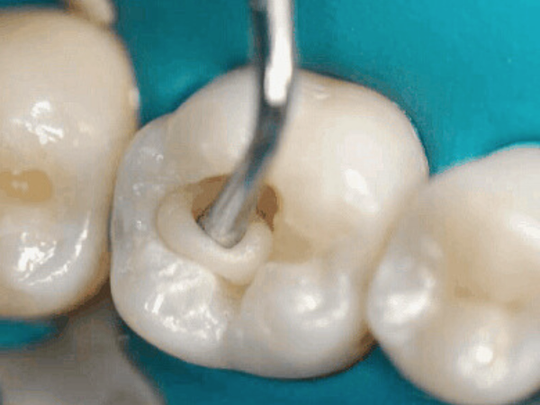 마곡역치과_ 1. 글래스아이오노머(GI) 특징과 장단점 관련 이미지 7