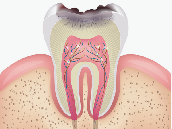 마곡동치과_ 1. 크라운 치료가 필요한 5가지 경우 관련 이미지 2