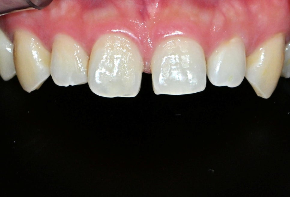 [ Magok Laminate_09 ] Laminate Veneers: These Misconceptions Are Common image 2