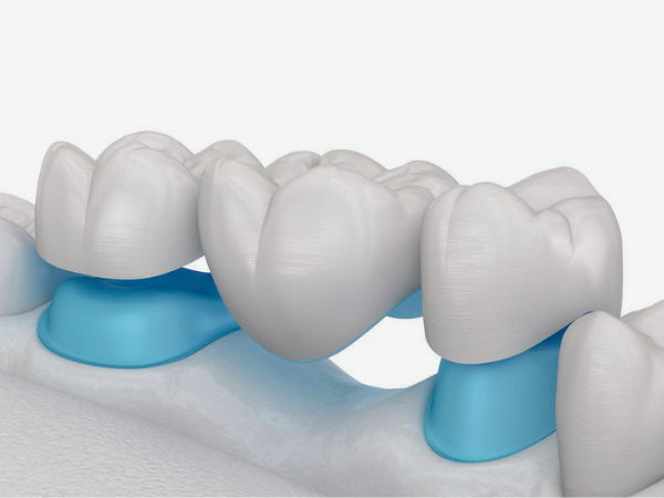마곡역치과_4. 브릿지 치료 단점과 수명, 얼마나 오래 사용할 수 있을까요? 관련 이미지 1