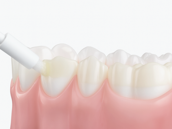 마곡역치과_&ldquo;바니시, 이렇게 진행됩니다!&rdquo; [3. 치과 불소도포 과정] 관련 이미지 4