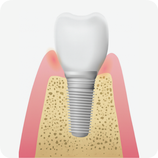 마곡동치과_"조용히 시작해 결국 흔들리는 이유" [ 3. 임플란트 주위염 진행 과정 ] 관련 이미지 1