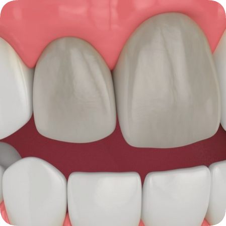 마곡역치과_ &ldquo;죽은 치아도 다시 하얘진다!&rdquo; [4. 실활치 미백치료 특징과 과정] 관련 이미지 1