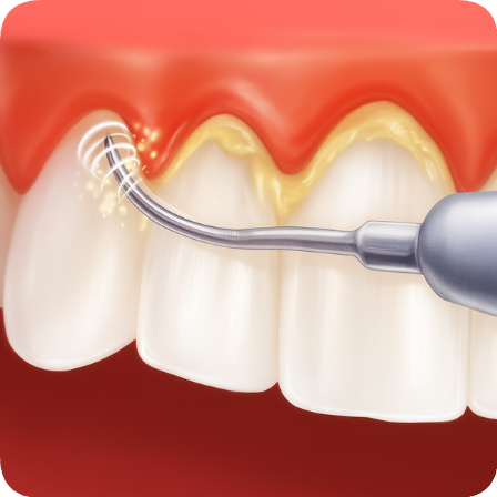 마곡치과_"스케일링에도 스타일이 있다?" [ 3. 에어플로우와 일반 스케일링 비교 ] 관련 이미지 1