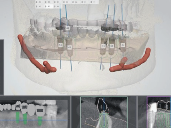 마곡치과_"기존 임플란트와 뭐가 다른가요" [1.3D 네비게이션 임플란트 기본] 관련 이미지 2