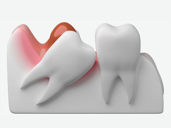 마곡동치과_1. 사랑니염증 원인, 왜 유독 사랑니만 문제를 만들까요? 관련 이미지 1
