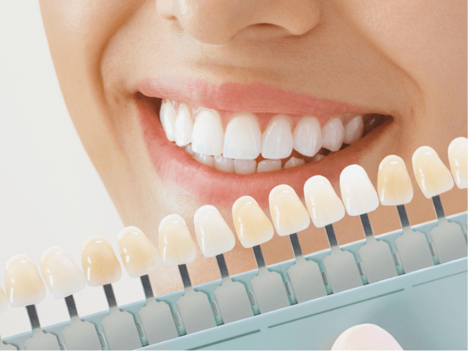 마곡역치과_ 하얀 치아 오래 가는 6가지 관리 루틴 [ 6. 치아 미백 후 주의사항 ] 관련 이미지 1