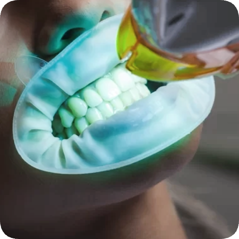 마곡동치과_전문가 미백 관련 이미지 6