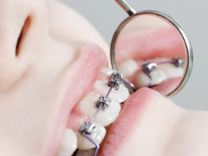 마곡역치과_2. 스케일링 주기, 얼마나 자주 받아야 할까? 소요시간까지 총정리 관련 이미지 4