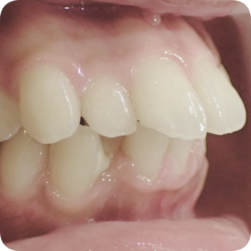 마곡동치과_2. 무삭제 라미네이트가 불가능한 경우 관련 이미지 1