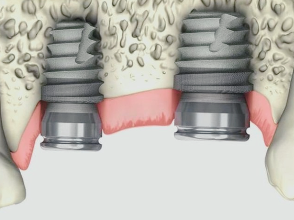 마곡동치과_3. 상악동거상술 없이 임플란트 가능할까요? 되는 조건 정리 관련 이미지 2