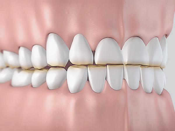 마곡치과_ 3. 이갈이 장치 종류별 특징, 하드형 vs 소프트형 비교 관련 이미지 1
