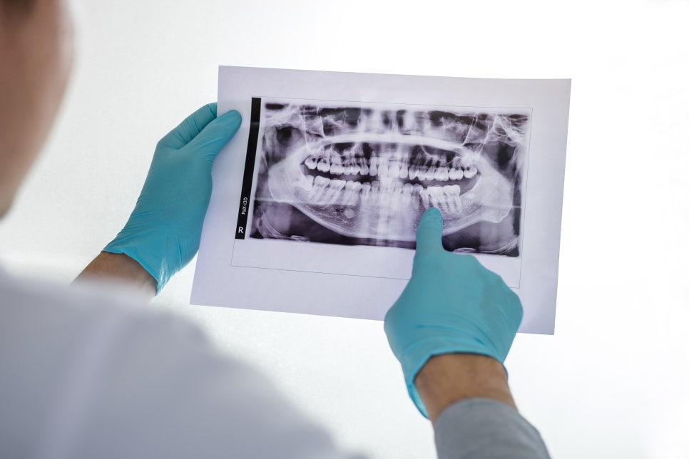 [ Magok Dental Clinic_03 ] I Left My Wisdom Tooth Alone, and It Even Caused Decay in the Tooth Next to It - What Happens When You Leave It Untreated image 5