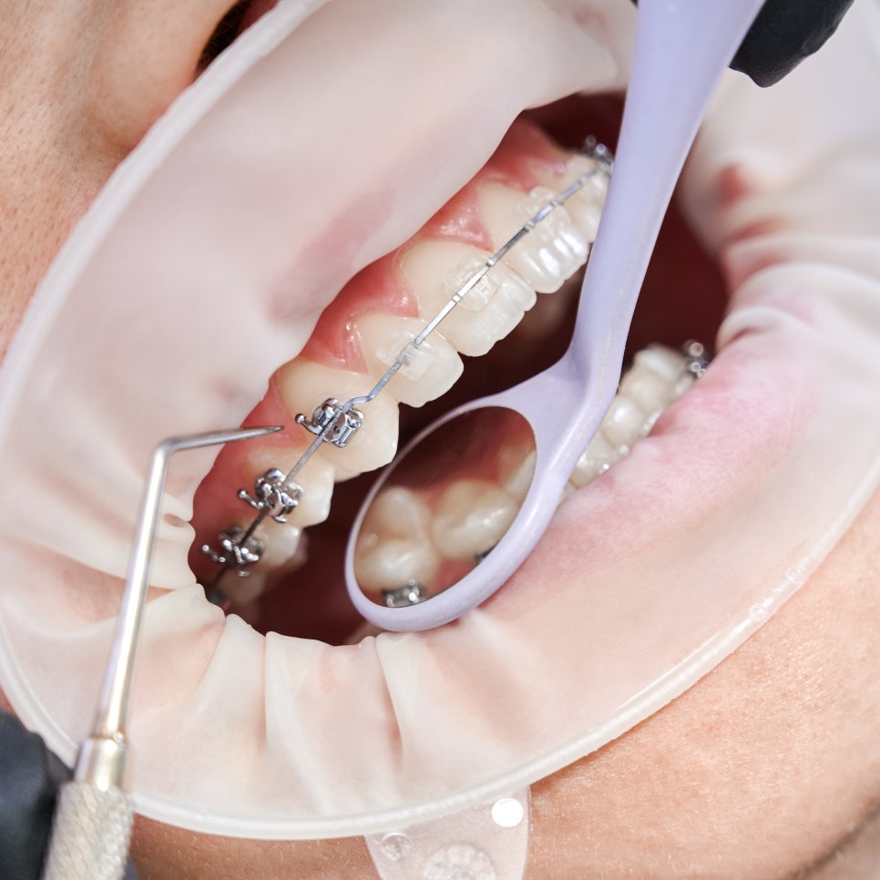 [ Magok Veneers_03 ] When Are Veneers Suitable? A Summary of Indications image 6