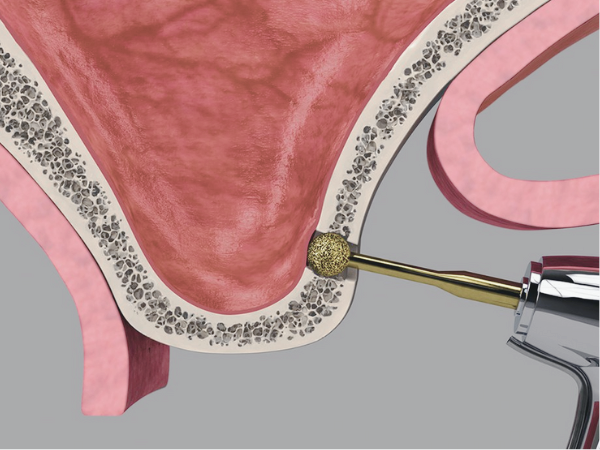 마곡치과_3. 상악동 거상술 측방 접근법, 언제 어떻게 진행될까? 관련 이미지 1