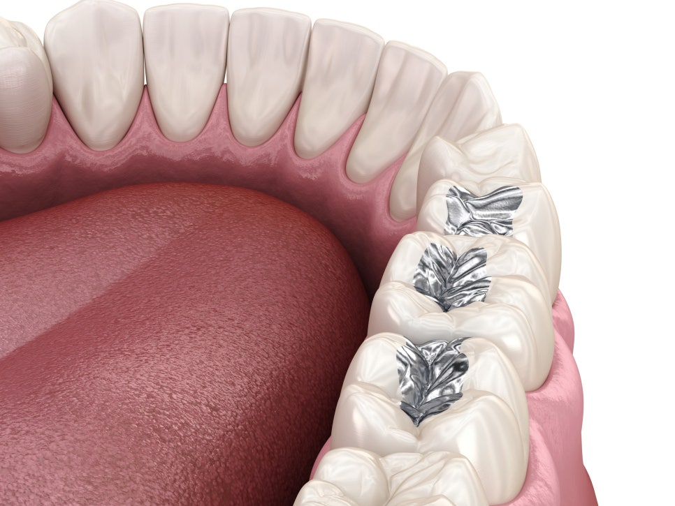 마곡치과_1. 아말감 충전, 아직 있어도 괜찮을까요? 수은 걱정에 대한 현실 답변 관련 이미지 3