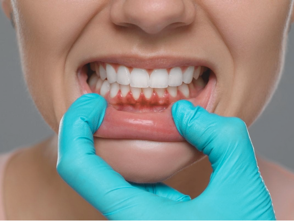 Maggok-dong Dental Clinic_“Signs That Your Gums Are Receding” [2. Step-by-Step Progression of Gingival Recession and Self-Diagnosis Checklist] image 4