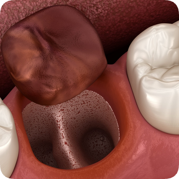 마곡역치과_5. 사랑니 발치 후 주의사항, 잘 뽑았으면, 잘 관리해야죠? 관련 이미지 10