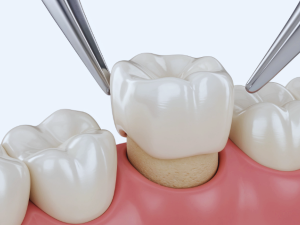 마곡동치과_4. 오래된 아말감 제거 후 치료 방법, 레진, 인레이, 크라운 언제 필요할까? 관련 이미지 4