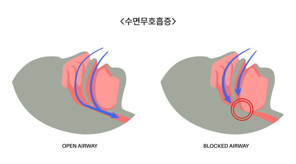 [ 마곡역치과_3 ] 코골이 방치하면 어떻게 될까요? 수면무호흡증까지 이어지는 과정 관련 이미지 1