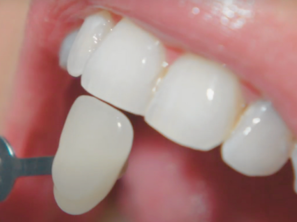 마곡치과_" 짧은 시간, 확실한 톤업" [2. 생활치 전문가 미백치료 특징과 과정 관련 이미지 6