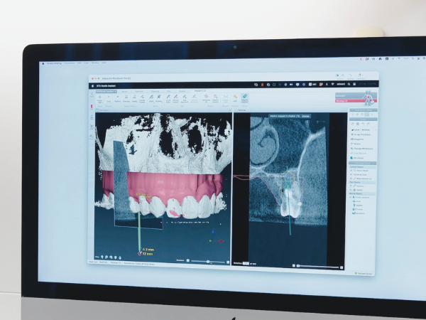 마곡치과_"기존 임플란트와 뭐가 다른가요" [1.3D 네비게이션 임플란트 기본] 관련 이미지 1