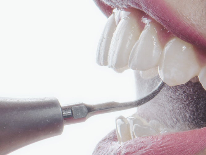 마곡 치과_ 당일 인레이 보철 셋팅 시스템을 소개합니다.( feat. 저스트 스캔) 관련 이미지 7