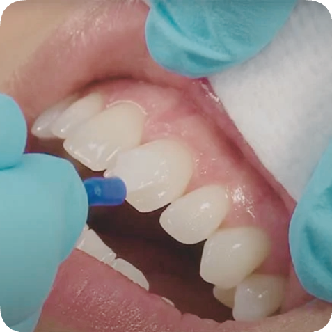 마곡동치과_"지금 바로 실천하세요!" [ 5. 충치 예방 관리법 ] 관련 이미지 3