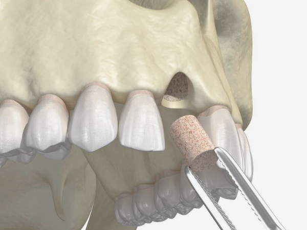 마곡동치과_&ldquo;왜 가격이 다를까?&rdquo;[4. 3D 네비게이션 임플란트 비용과 보험 그리고 선택기준] 관련 이미지 6