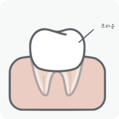 마곡동치과_ "치아 속 구조 복원 프로젝트" [2. 신경치료 단계별 진행 과정 ] 관련 이미지 6