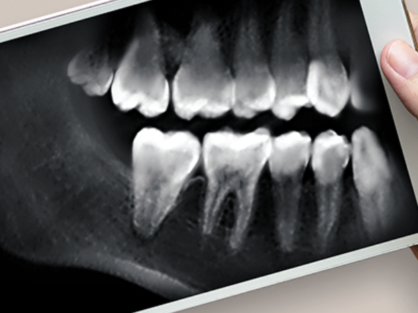 Magok-dong Dental Clinic_2. Why Are There So Many Types of Dental X-ray Radiation? A Clear Summary image 3