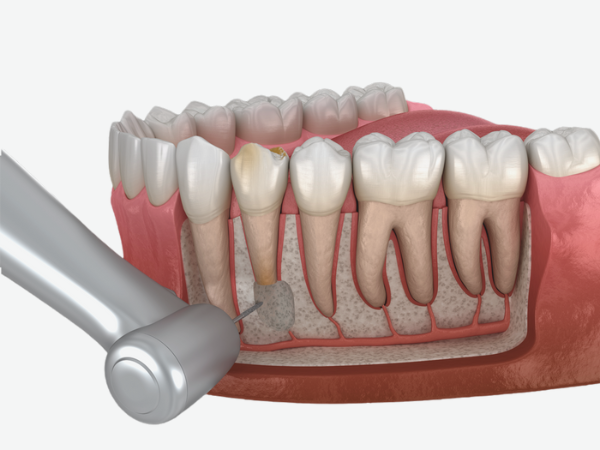 마곡동치과_&ldquo;신경치료했는데 또 아파요?&rdquo; [1. 치근단절제술이 필요한 경우] 관련 이미지 1
