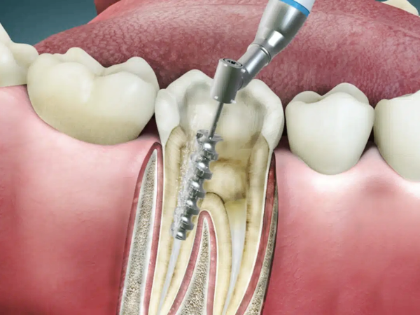 마곡역치과_ 1. 신경치료 후 통증, 왜 생길까? 관련 이미지 2