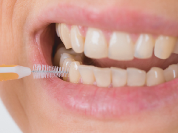 마곡동치과_3. 양치 열심히 하는데 음식이 낀다면? 치간칫솔이 필요한 신호일 수 있습니다 관련 이미지 1