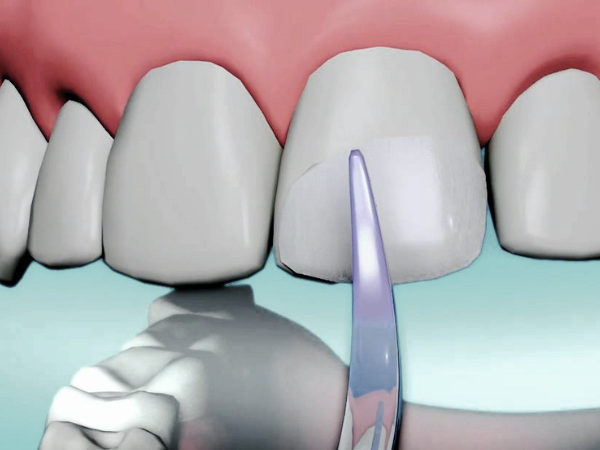 마곡역치과_&ldquo;금의 깊이가 다르면 치료도 달라집니다!&rdquo;[3. 치아 금(균열) 치료] 관련 이미지 3