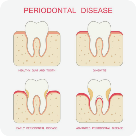 마곡동치과_1. 치주질환이란? (치은염과 치주염의 차이점) 관련 이미지 2