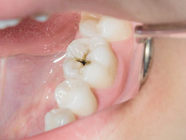 Maggok Station Dental Clinic_“Prevent Cavities Before They Start” [1. What Is Pit and Fissure Sealant?] image 4