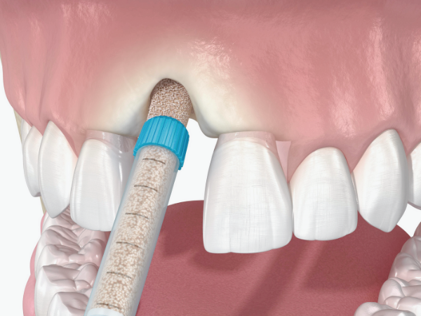 마곡동치과_1. 임플란트 치료에 관련 이미지 9