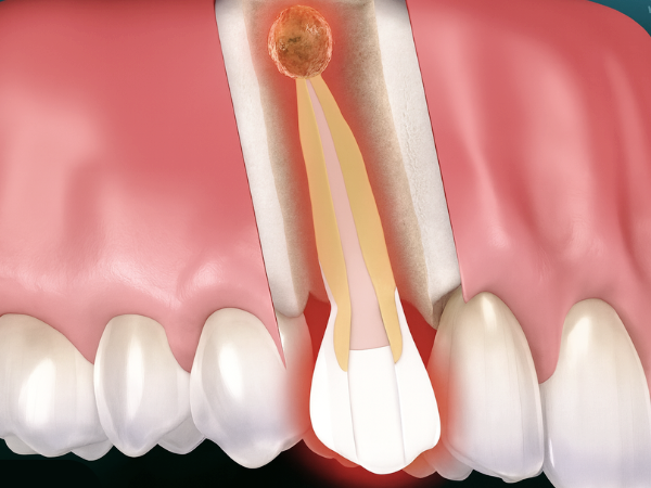 마곡역치과_ 1. 신경치료 후 통증, 왜 생길까? 관련 이미지 1